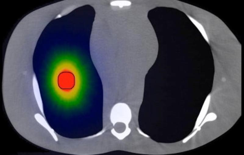 targeted radiation via high-energy electrons directed into a model lung