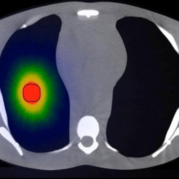 targeted radiation via high-energy electrons directed into a model lung